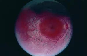 enhanced scone syndrome american academy  ophthalmology