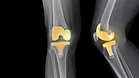 knee cap replacement  total knee replacement doctorvisit