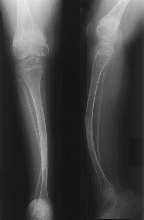 Osteogenesis Imperfecta Brittle Bone Disease