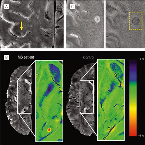 magnetic resonance techniques in multiple sclerosis the present and the future demyelinating