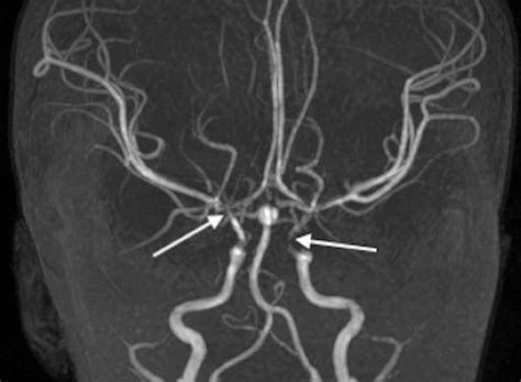 rare case  basilar artery aneurysm   young child bmj case reports