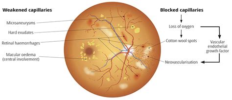community eye health journal grading diabetic retinopathy