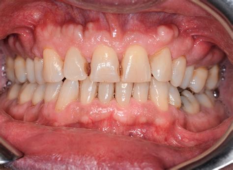 oral maxillary exostosis limongelli  clinical case reports