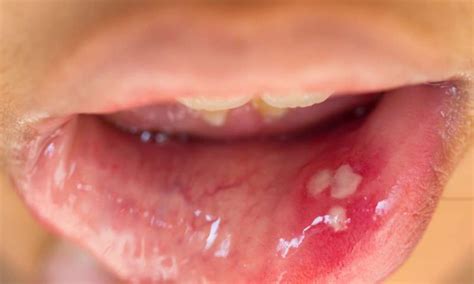 Hpv In The Mouth Symptoms Causes And Treatment Worlds