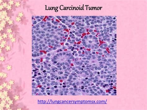 Lung Carcinoid Tumor Ppt