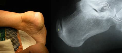 haglunds deformity   foot  ankle clinic