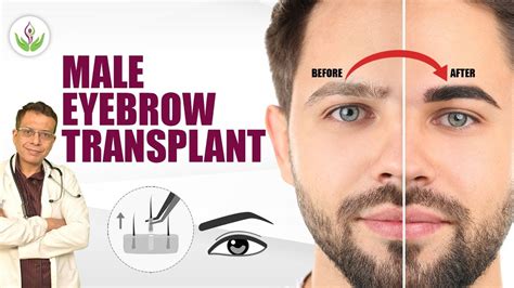 Male Eyebrow Transplant आईब्रो ट्रांसप्लांट Procedure In Delhi Care