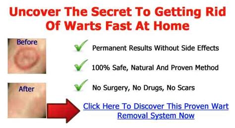 how to get rid of genital warts naturally 7 proven cures