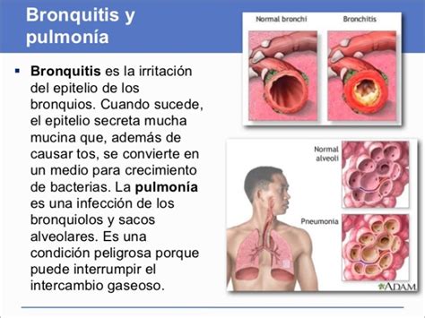 Cuadros Comparativos Entre Pulmonía Y Bronquitis Cuadro Comparativo