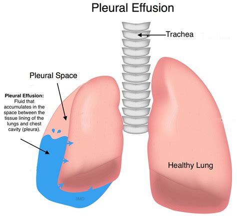 pleural effusion pediatric pulmonologists