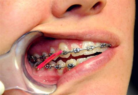 What Do The Elastic Rubber Bands On Braces Do Ask An