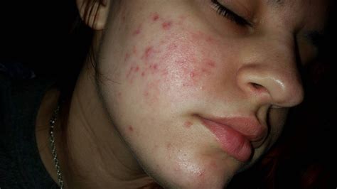 acne scars  marks hyperpigmentation reddark marks  mraverty acneorg community