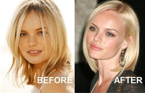 Kate Bosworth Nose Job And Lip Injections Lip