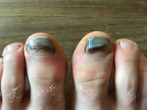 Black Toenail Hall Of Fame Ultramarathon News Podcasts And Product