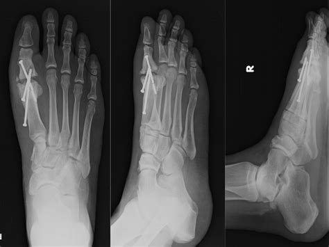 cureus antibiotic spacer arthroplasty  revision mtp arthrodesis