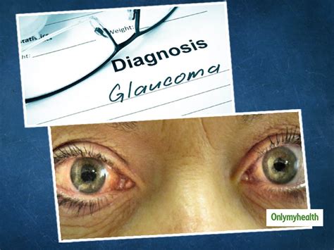 What Is Glaucoma Here Are Its Symptoms Causes And Treatment