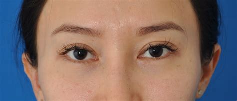 asian blepharoplasty overview cost recovery   aedit