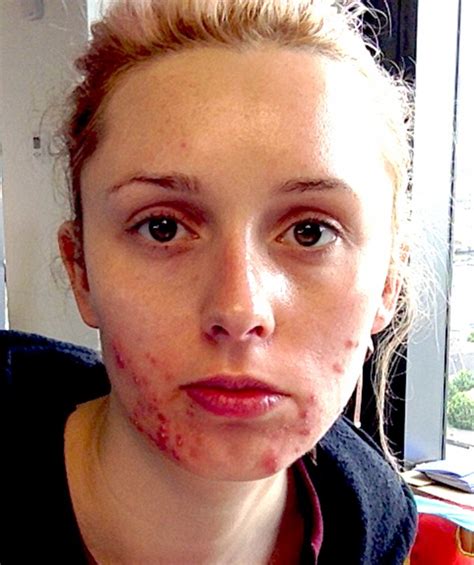 woman with severe acne finally has clear skin and now hopes to find