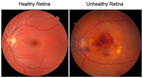 Six Of The Most Common Eye Diseases