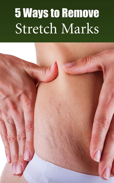5 Ways To Remove Stretch Marks Naturally Stretch Mark Removal