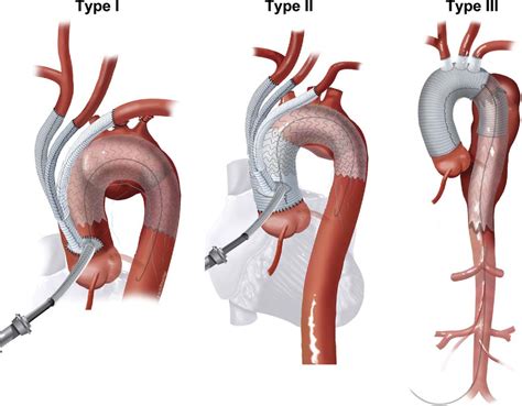figure  hybrid repair  aortic arch aneurysms combined open