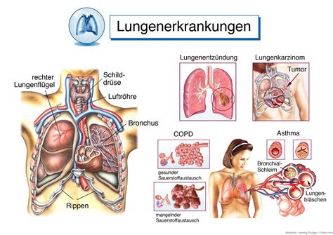 lungenerkrankungen feinstaub weckt schlafende viren  der lunge