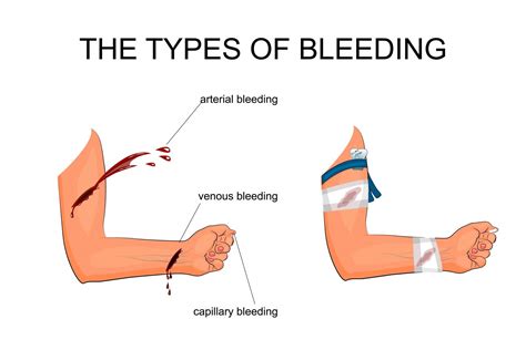 types  bleeding    control  unifirst  aid safety