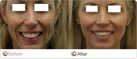 jawline fillers contouring and costs sydney gold coast canberra and adelaide