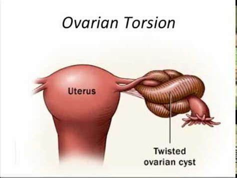 ovarian torsion youtube
