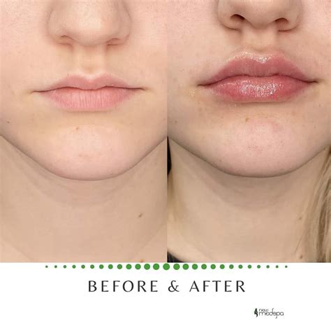 lip augmentation    lip augmentation botox fillers