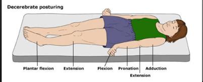 glasgow coma scale abnormal flexion