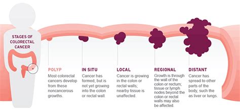 Colon Cancer Staging Chart