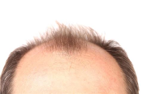 baldness how close are we to a cure