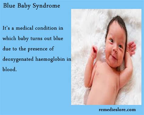 blue baby syndrome symptoms  diagnosis remedies lore