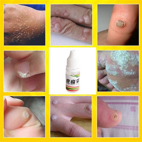 chinese medicine treatment foot corn removal plantar warts