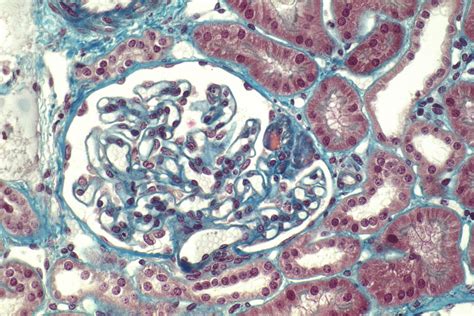 novel drug shows promise for fsgs renal and urology news