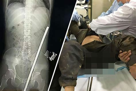 Builder Impaled In The Scrotum By Rusty Metal Bar Survives