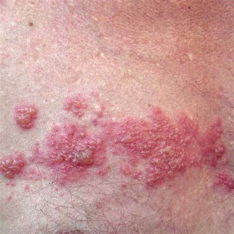 genital herpes infection symptoms and other causes
