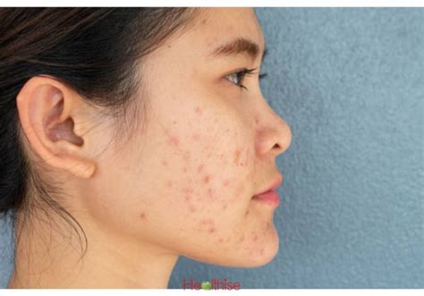 Healthise Acne Pimples Treatment 33 ™