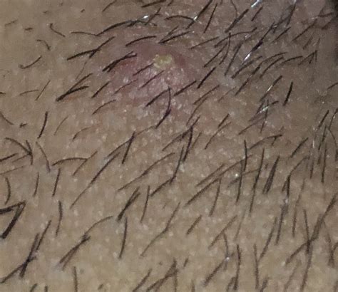 I Got This Bump Near My Vagina Two Or Three Days After I Shaved Is It