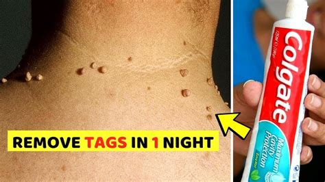 remove skin tag in 1 night from your neck eyelids or face world s