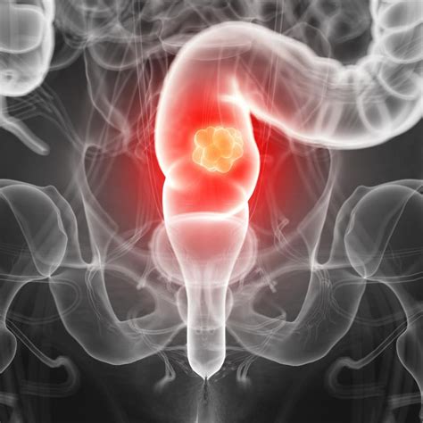 Multimodal Treatment Improves Symptoms Survival In Stage Iv Rectal