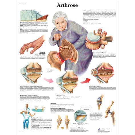 arthrose   scientific vrl arthritis patient education arthritis models