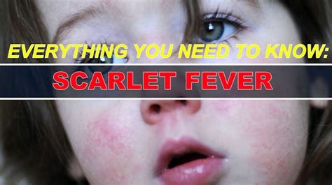 Scarlet Fever Cases On The Rise What You Can Do To Detect It And Stop