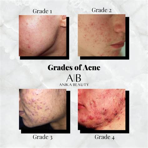Teresa Paquin Acne And The Different Grades From One To