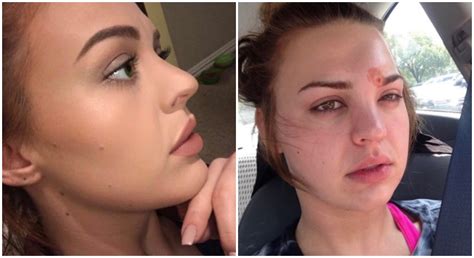 This Woman Popped Her Pimple And Ended Up In The Emergency