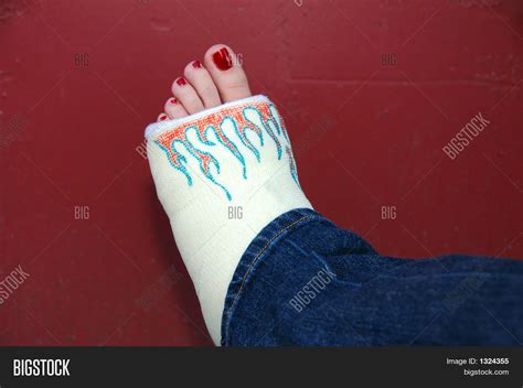 girls broken leg image photo bigstock