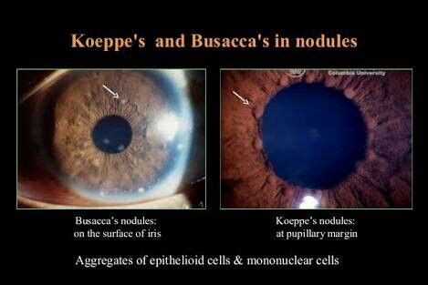 koeppe  busca nodule   granulomatous uveitis optometry school optometry students