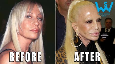 Worst Celebrity Plastic Surgery Disasters Laxary
