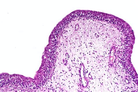 Urethritis Clinical Features Management Teachmesurgery